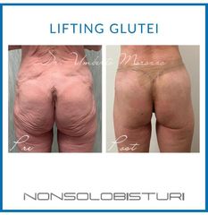 Lifting glutei - Nonsolobisturi