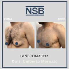 Ginecomastia - Nonsolobisturi