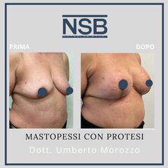 Mastopessi - Nonsolobisturi