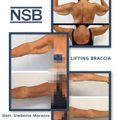 Lifting braccia - Nonsolobisturi