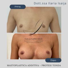 Mastoplastica additiva - Nonsolobisturi