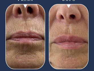 Filler prima e dopo - 878851