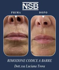 Nonsolobisturi Filler "codice a barre"