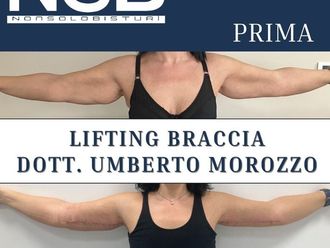 Liposcultura prima e dopo - 878915
