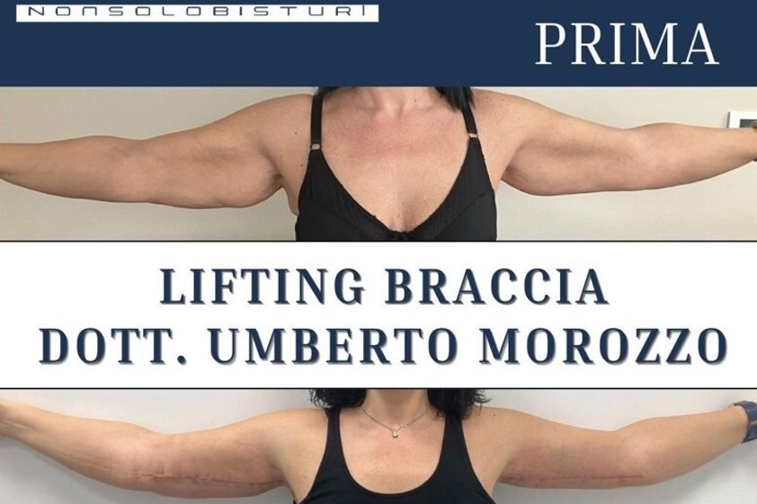 Liposcultura prima e dopo - 878915