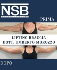 Nonsolobisturi Lifting braccia Dr U. Morozzo