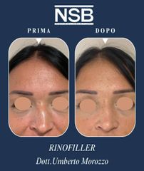Nonsolobisturi Rinofiller Dr U. Marozzo
