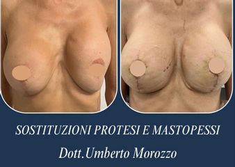 Nonsolobisturi Sostituzione Protesi e Mastopessi
