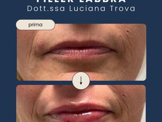 Filler labbra prima e dopo - 879587