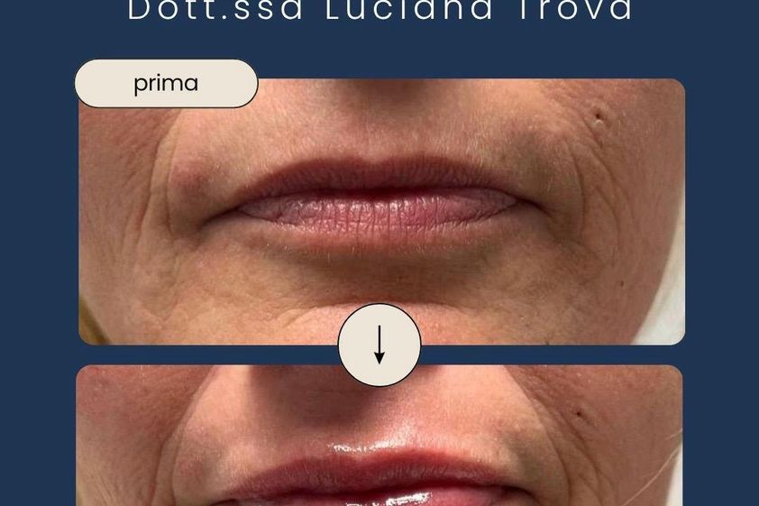 Filler labbra prima e dopo - 879587