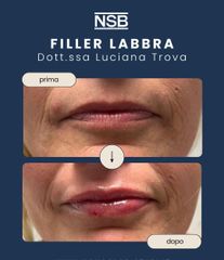 Nonsolobisturi Filler labbra