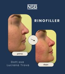 Nonsolobisturi Rinofiller