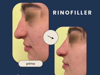 Rinofiller prima e dopo - 879725