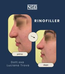 Nonsolobisturi Rinofiller Dottoressa Luciana Trova