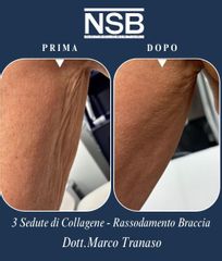 Nonsolobisturi 3 sedute di Collagene Dottor Marco Tranaso