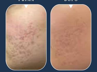 Acne prima e dopo - 880388