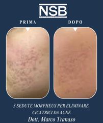 Nonsolobisturi Morpheus per eliminare cicatrici da acne Dr Marco Tranaso