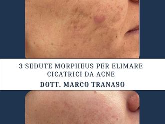 Acne prima e dopo - 880389