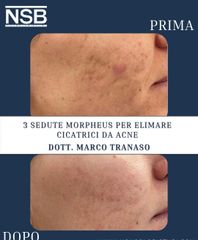 Nonsolobisturi 3 sedute Morpheus per eliminare cicatrici da acne Dr Marco Tranaso