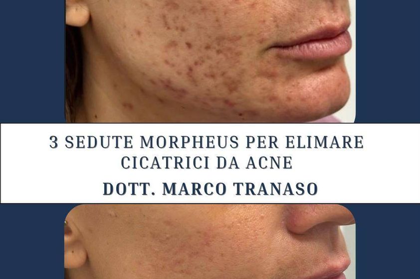 Acne prima e dopo - 881426