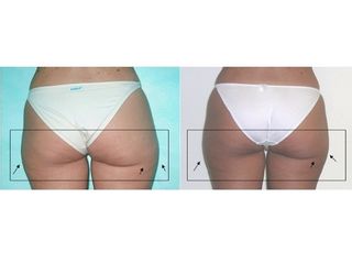 glutei pre e post