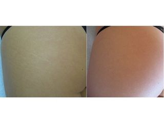 Smagliature prima e dopo