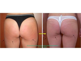 Cellulite prima e dopo