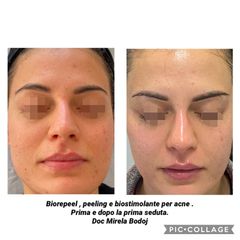 Trattamenti acne e cicatrici da acne - Dott.ssa Mirela Bodoj