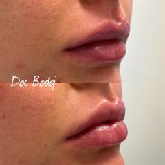 Filler labbra - Dott.ssa Mirela Bodoj