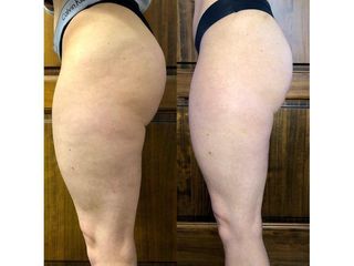 Cellulite prima e dopo