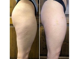 Cellulite prima e dopo