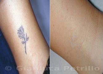 Rimozione tatuaggio prima e dopo