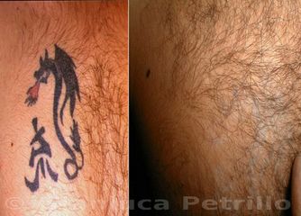 Rimozione tatuaggio prima dopo