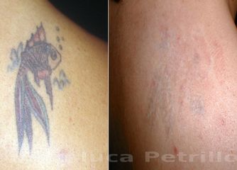 Rimozione tatuaggio prima dopo