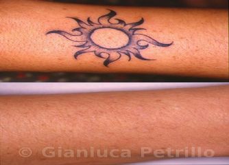 Rimozione tatuaggio prima e dopo