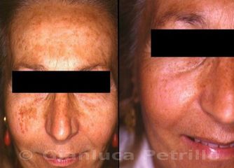 Melasma prima e dopo