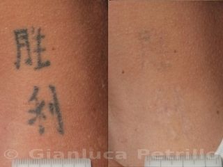 Rimozione tatuaggio prima dopo