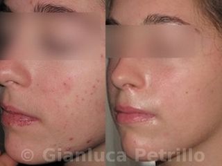 Acne prima e dopo