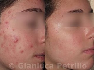 Acne prima e dopo