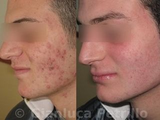 Acne prima e dopo