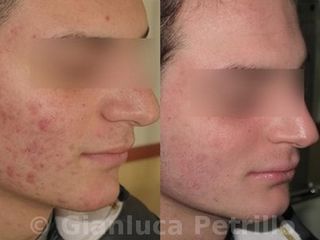 Acne prima e dopo