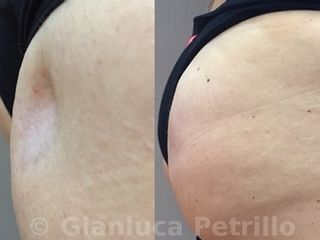 filler glutei prima e dopo