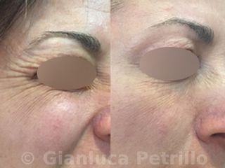 filler contorno occhi prima e dopo