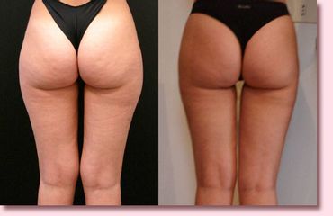 Lipoaspirazione prima e dopo