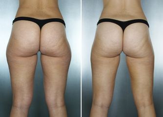 Lipolaser prima e dopo