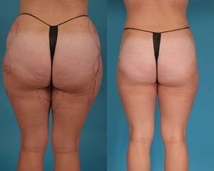 Lipolaser prima e dopo