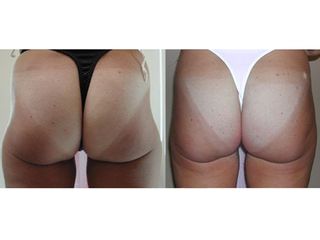 Lipolaser prima e dopo