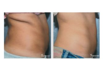 Velashape prima e dopo