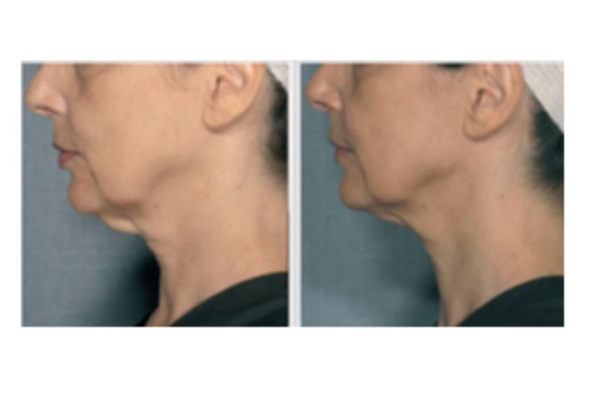 Velashape prima e dopo - 749991