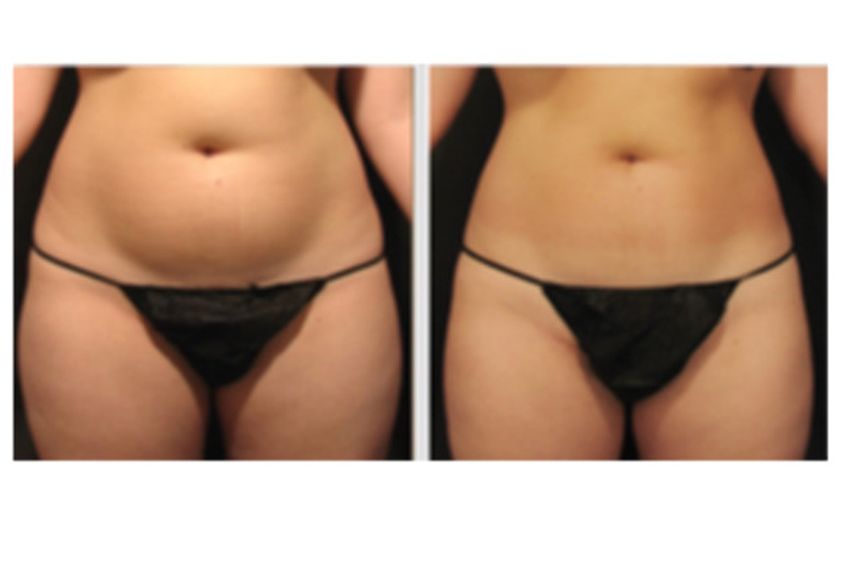 Velashape prima e dopo - 749992